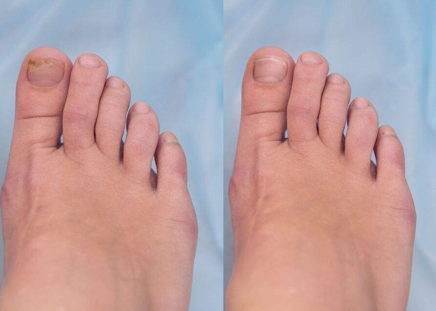 Nail fungus before and after treatment