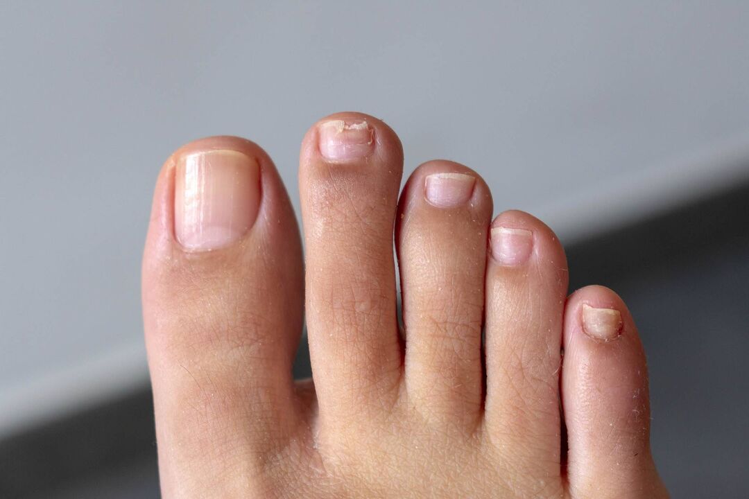 Symptoms of toenail fungus